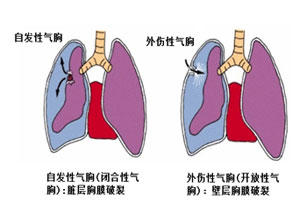 气胸揭秘，症状、成因与防治，澳门视角深度解读！